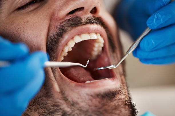 Best Emergency Tooth Extraction in Ranson, WV